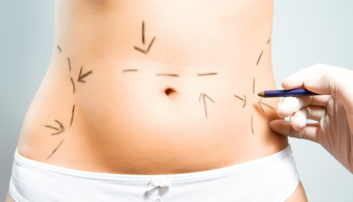 Liposuccion au laser de l'abdomen. Photo, réhabilitation, conséquences, prix, avis