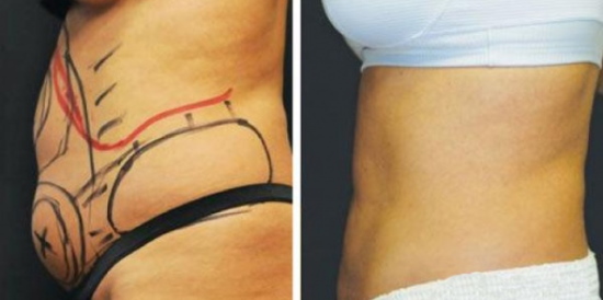 Liposuccion au laser de l'abdomen. Photo, réhabilitation, conséquences, prix, avis