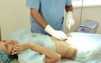 Liposuccion au laser de l'abdomen. Photo, réhabilitation, conséquences, prix, avis