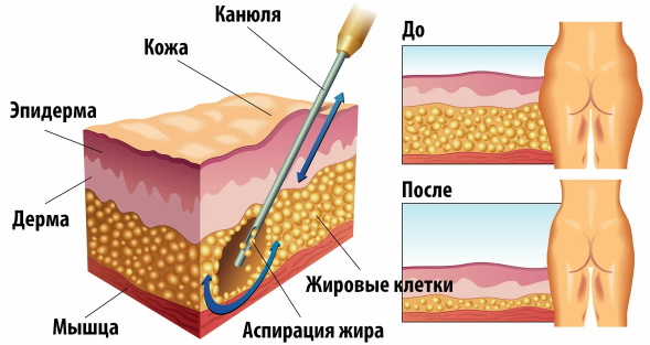 Liposuccion au laser de l'abdomen. Photo, réhabilitation, conséquences, prix, avis