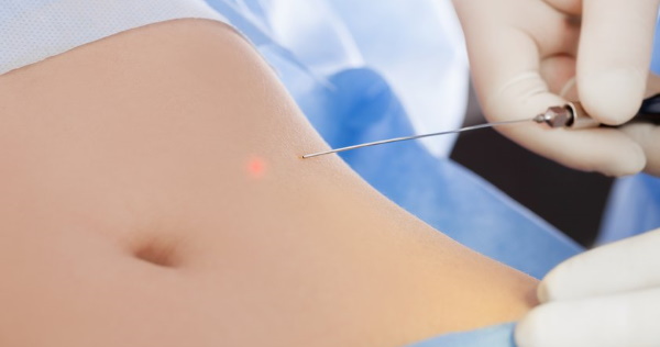 Liposuccion au laser de l'abdomen. Photo, réhabilitation, conséquences, prix, avis