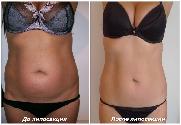 Liposuccion au laser de l'abdomen. Photo, réhabilitation, conséquences, prix, avis