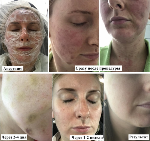 Plasmolifting du visage. Qu'est-ce que c'est, photos avant et après les injections, le coût du lifting plasma, des critiques