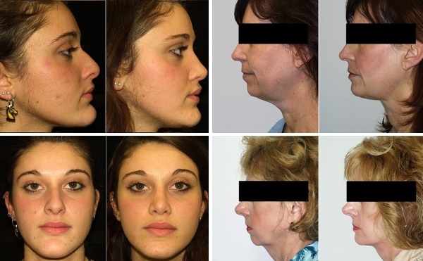 Contour du visage à partir du double menton. Photos avant et après la chirurgie, prix, avis