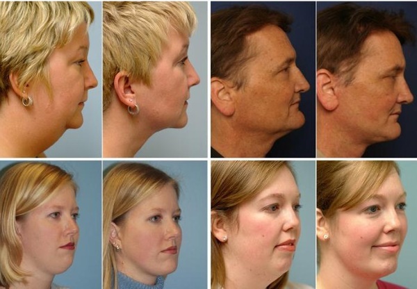 Contour du visage à partir du double menton. Photos avant et après la chirurgie, prix, avis