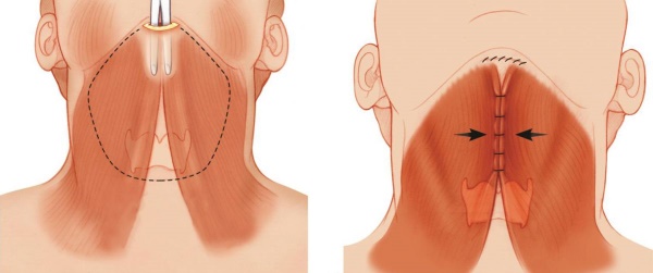 Contour du visage à partir du double menton. Photos avant et après la chirurgie, prix, avis