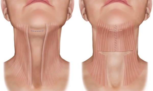 Contour du visage à partir du double menton. Photos avant et après la chirurgie, prix, avis