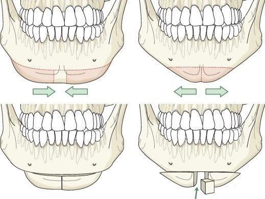 Contour du visage à partir du double menton. Photos avant et après la chirurgie, prix, avis