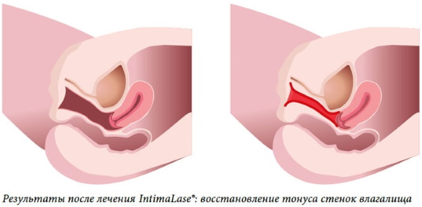 Rajeunissement au laser du vagin (vaginoplastie après l'accouchement). Avis, prix