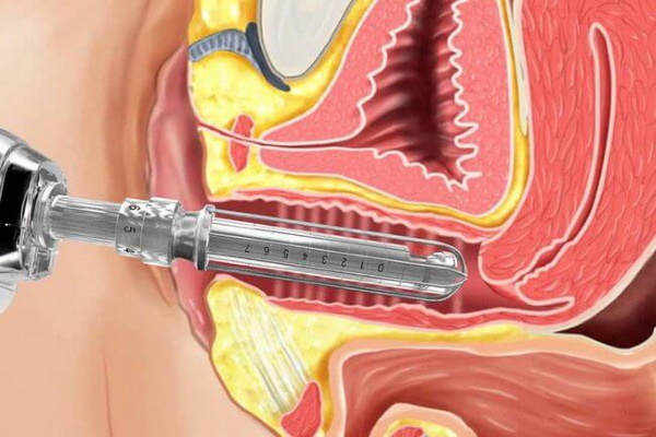 Rajeunissement au laser du vagin (vaginoplastie après l'accouchement). Avis, prix