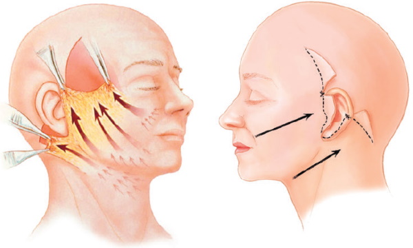 Rides du cou. Comment se débarrasser des exercices, des charges, des plastiques de contour, des injections