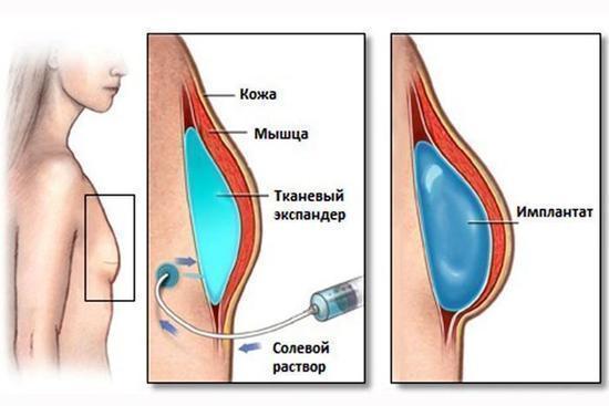 Où obtenir une chirurgie plastique mammaire. Prix, avis, photos avant et après