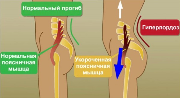 Le muscle iliopsoas. Exercices de renforcement, étirements, comment pomper