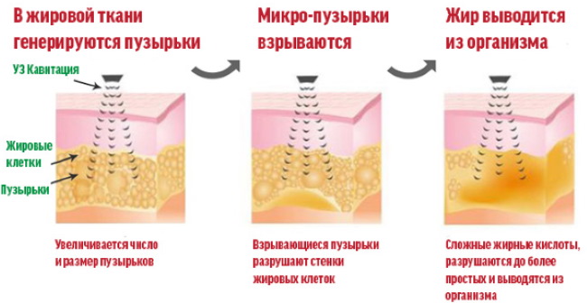 Liposuccion des cuisses, jambes épaisses chez la femme. Photos avant et après, prix, avis