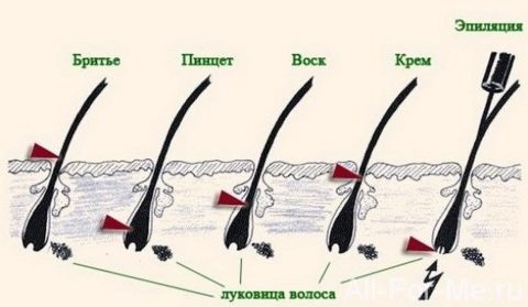 Comment épiler le visage, la poitrine, les jambes, le corps, les endroits intimes. Les moyens les plus efficaces