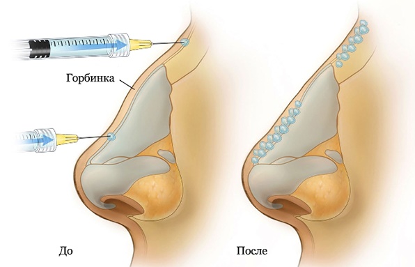 Une bosse sur le nez de la fille. Beau ou pas, comment enlever sans chirurgie, rhinoplastie