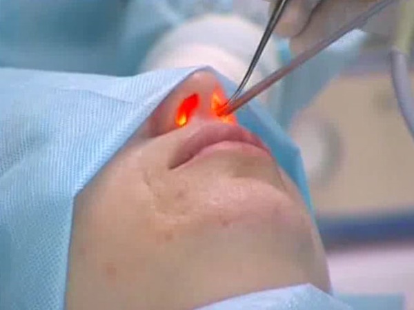 Une bosse sur le nez de la fille. Beau ou pas, comment enlever sans chirurgie, rhinoplastie