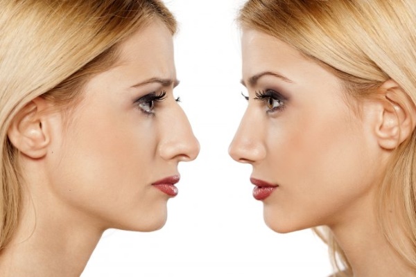 Une bosse sur le nez de la fille. Beau ou pas, comment enlever sans chirurgie, rhinoplastie