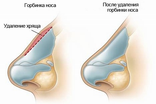 Une bosse sur le nez de la fille. Beau ou pas, comment enlever sans chirurgie, rhinoplastie