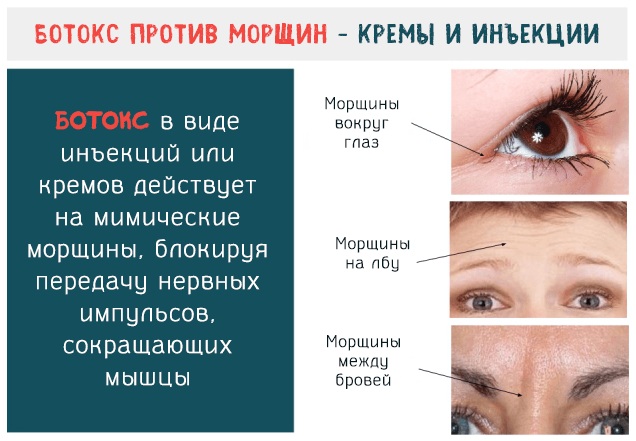 Analogues de Botox pour le visage de la production russe, France, Corée. Xeomin, Dysport, Relatox