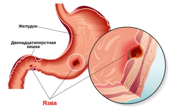 Nicotine (acide nicotinique) en injections. Instructions, indications d'utilisation, déroulement du traitement