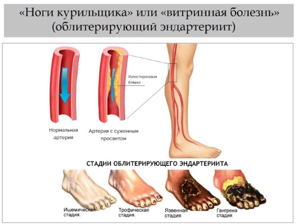 Nicotine (acide nicotinique) en injections. Instructions, indications d'utilisation, déroulement du traitement