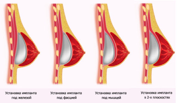 Forme tubulaire des glandes mammaires, des seins. Photo, correction sans chirurgie pour femmes, hommes