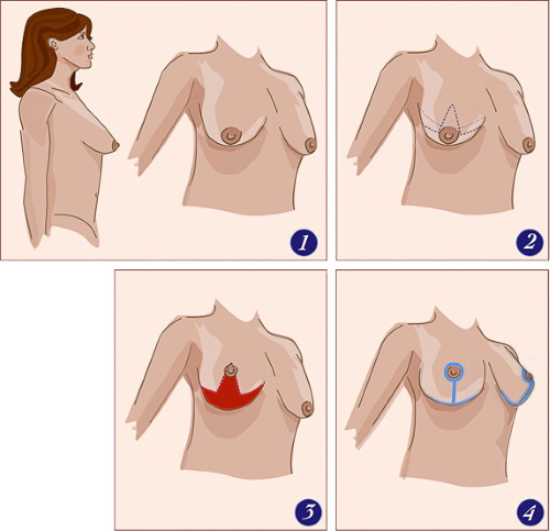 Forme tubulaire des glandes mammaires, des seins. Photo, correction sans chirurgie pour femmes, hommes