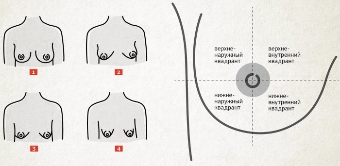 Forme tubulaire des glandes mammaires, des seins. Photo, correction sans chirurgie pour femmes, hommes