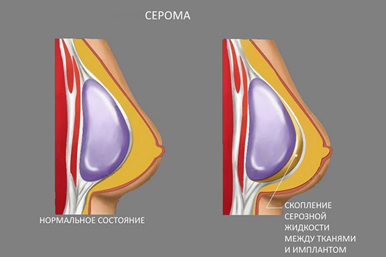 Forme tubulaire des glandes mammaires, des seins. Photo, correction sans chirurgie pour femmes, hommes