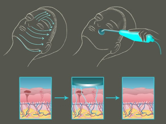 Nettoyer le visage d'un adolescent par une esthéticienne. Prix, avis