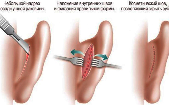 Chirurgia dell'orecchio per le orecchie cadenti. Quanto costa