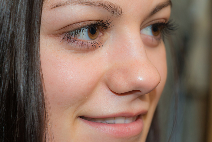 Les filles ont un nez large. Que faire, comment s'en débarrasser, rhinoplastie