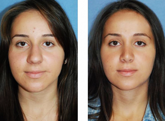 Les filles ont un nez large. Que faire, comment s'en débarrasser, rhinoplastie