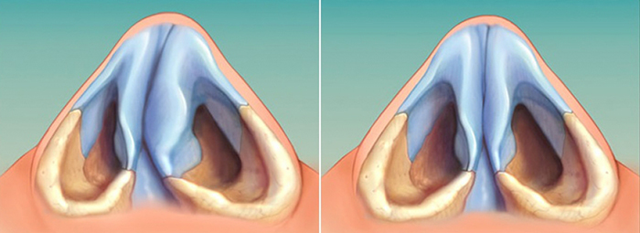 Les filles ont un nez large. Que faire, comment s'en débarrasser, rhinoplastie