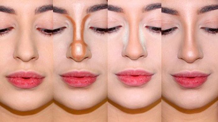 Les filles ont un nez large. Que faire, comment s'en débarrasser, rhinoplastie