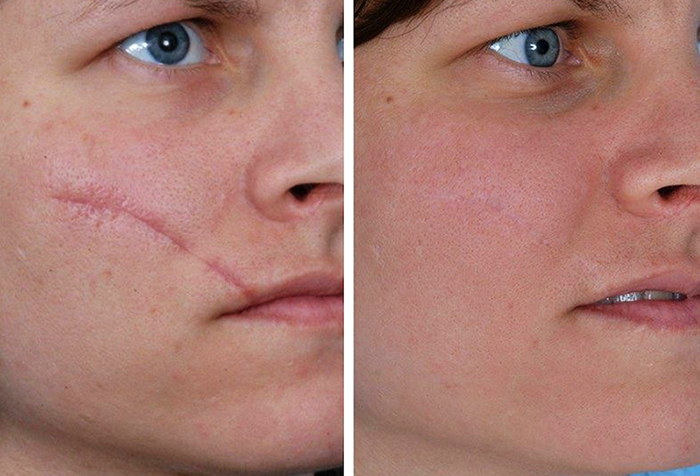 Élimination des cicatrices au laser sur le visage. Avis, photos avant et après, prix