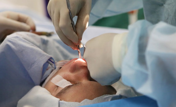 La fille a un gros nez. Photos avant et après la rhinoplastie