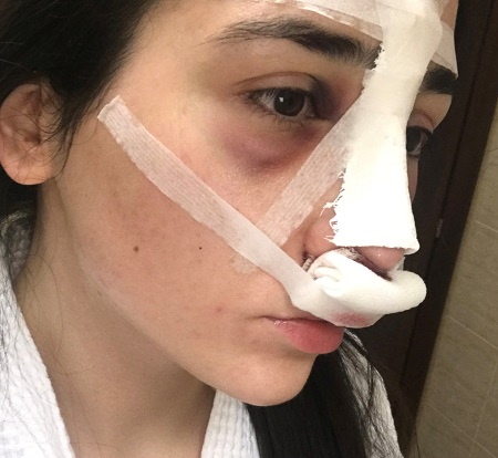 La fille a un gros nez. Photos avant et après la rhinoplastie