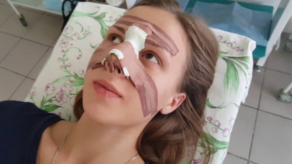 La fille a un gros nez. Photos avant et après la rhinoplastie