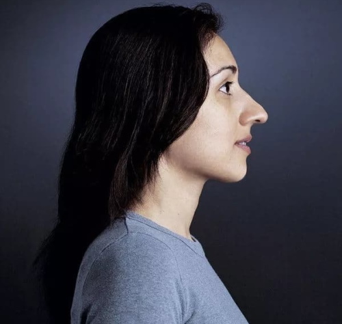 La fille a un long nez. Photos avant et après la rhinoplastie