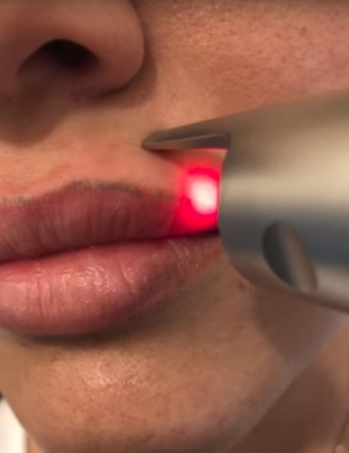 Élimination au laser du maquillage permanent (tatouage) des sourcils, des lèvres, des paupières