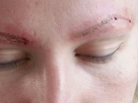 Élimination au laser du maquillage permanent (tatouage) des sourcils, des lèvres, des paupières