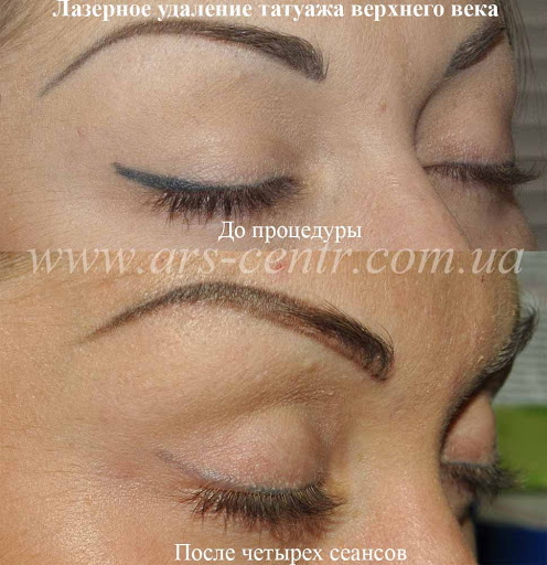 Élimination au laser du maquillage permanent (tatouage) des sourcils, des lèvres, des paupières