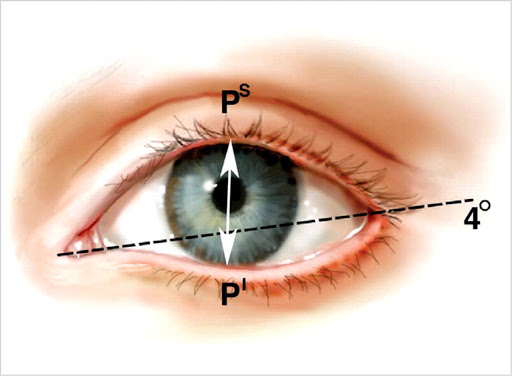 Les filles ont de petits yeux. Comment augmenter le prix de la chirurgie plastique