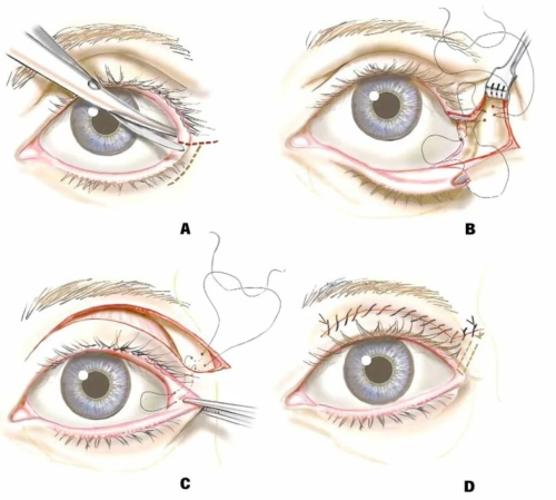 Les filles ont de petits yeux. Comment augmenter le prix de la chirurgie plastique