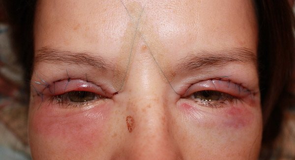 Les filles ont de petits yeux. Comment augmenter le prix de la chirurgie plastique