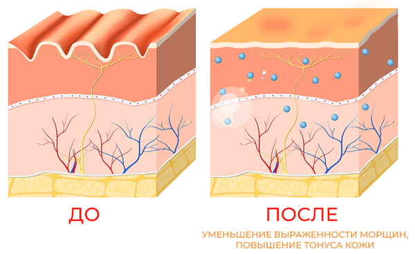 Revi (Revi et Revi Brilliants) un médicament pour la bio-revitalisation