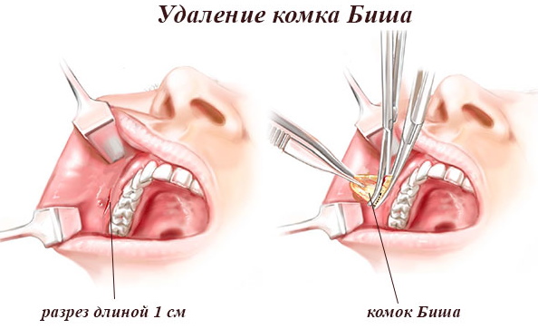 Les pommettes sont l'endroit sur le visage, la photo, l'anatomie, comment faire