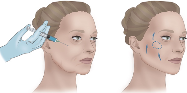 Les pommettes sont l'endroit sur le visage, la photo, l'anatomie, comment faire